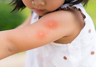 Waspada! Gigitan Nyamuk Sebabkan Reaksi Tubuh Ini